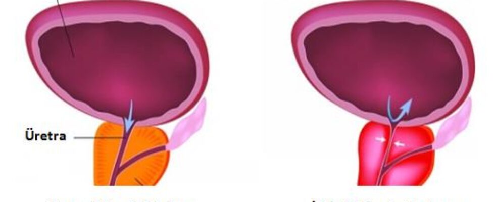 Prostat İltihabı ( Prostatit ) nedir ?