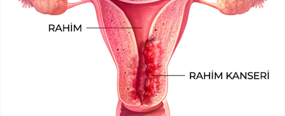 rahim-kanseri-resim